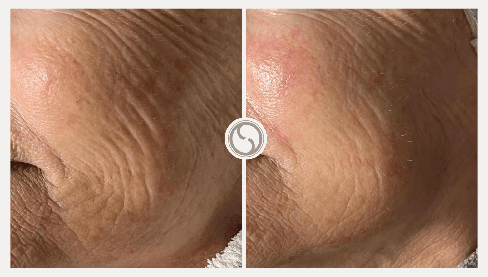 Dermatude Resultaten 6 (2)