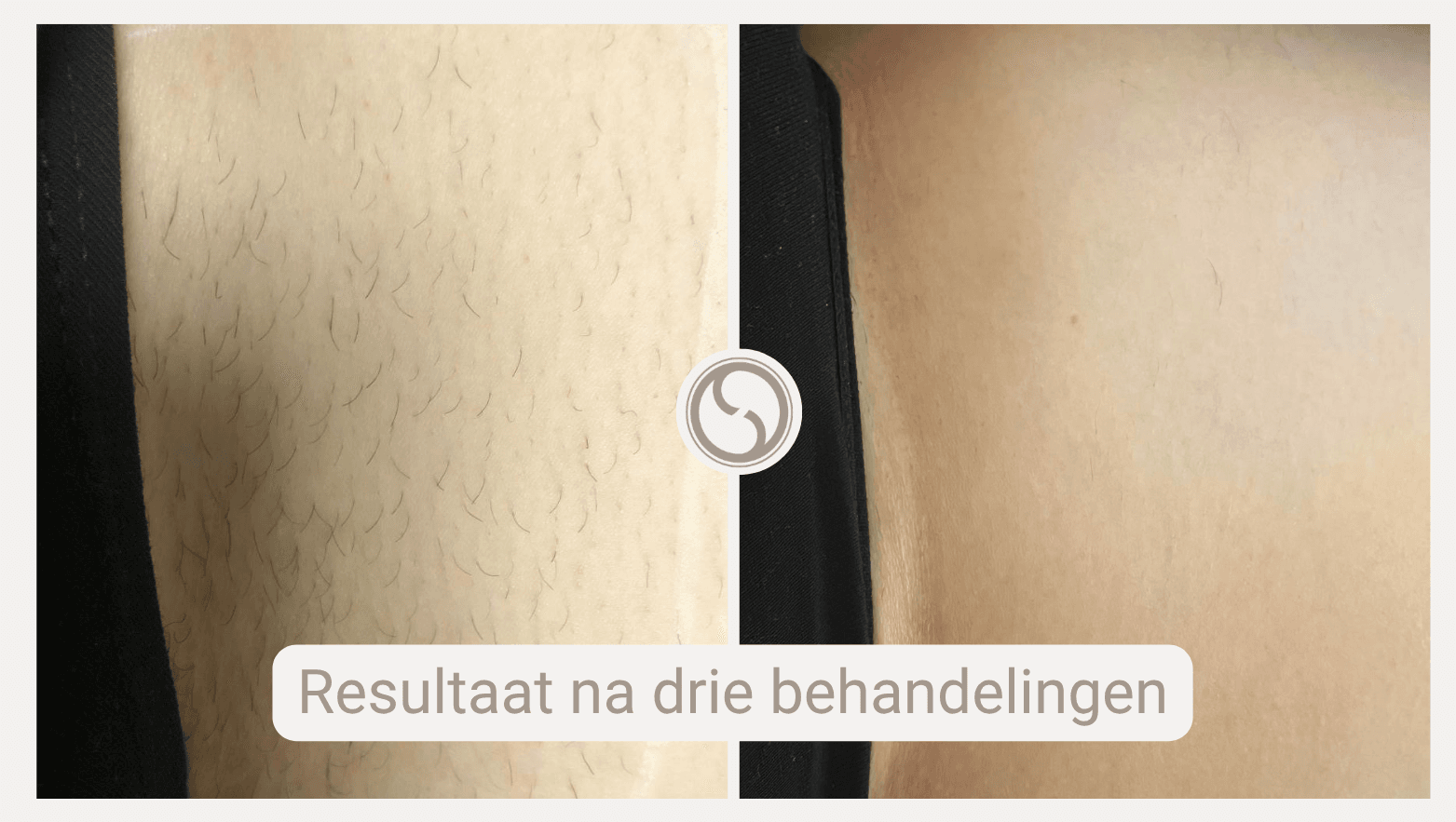 Laserontharing resultaten