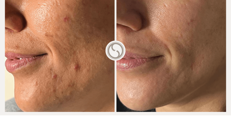 Chemische peeling Resultaten 1