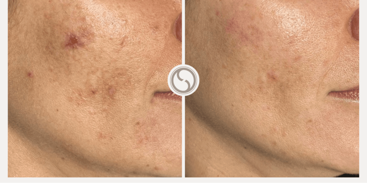 Chemische peeling Resultaten 2